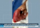 Hospital e Conselho de Enfermagem apuram caso de bebê que teria sofrido queimadura durante teste do pezinho